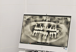 Раскололся зуб: что делать? | Статьи | Стоматология Ас-Стом в Санкт-Петербурге